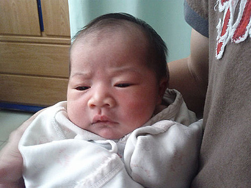 這是隔兩天的樣子,比較沒那麼浮腫了,但眼睛都不太睜開的,一臉憂鬱的樣子。